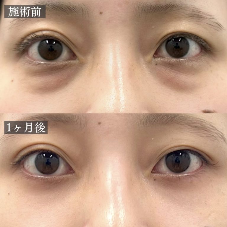 切らない目の下のクマ取り・たるみ（ふくらみ）取り