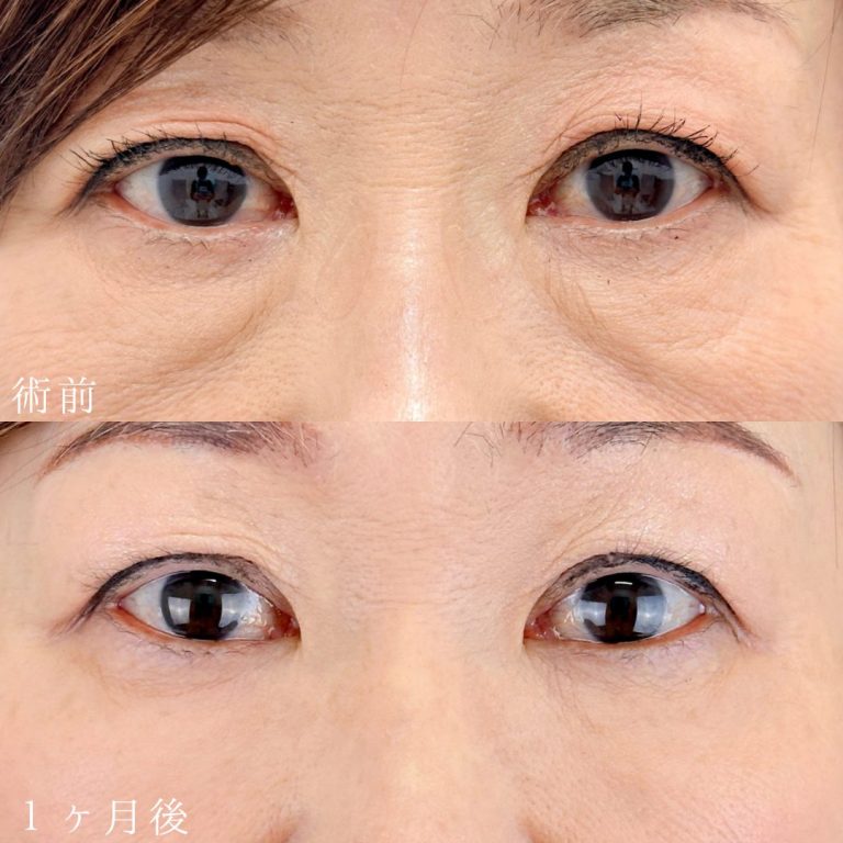 切らない目の下のクマ取り・たるみ（ふくらみ）取り